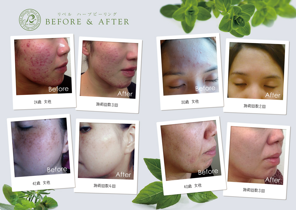 リベルハーブピーリング　ビフォアアプター