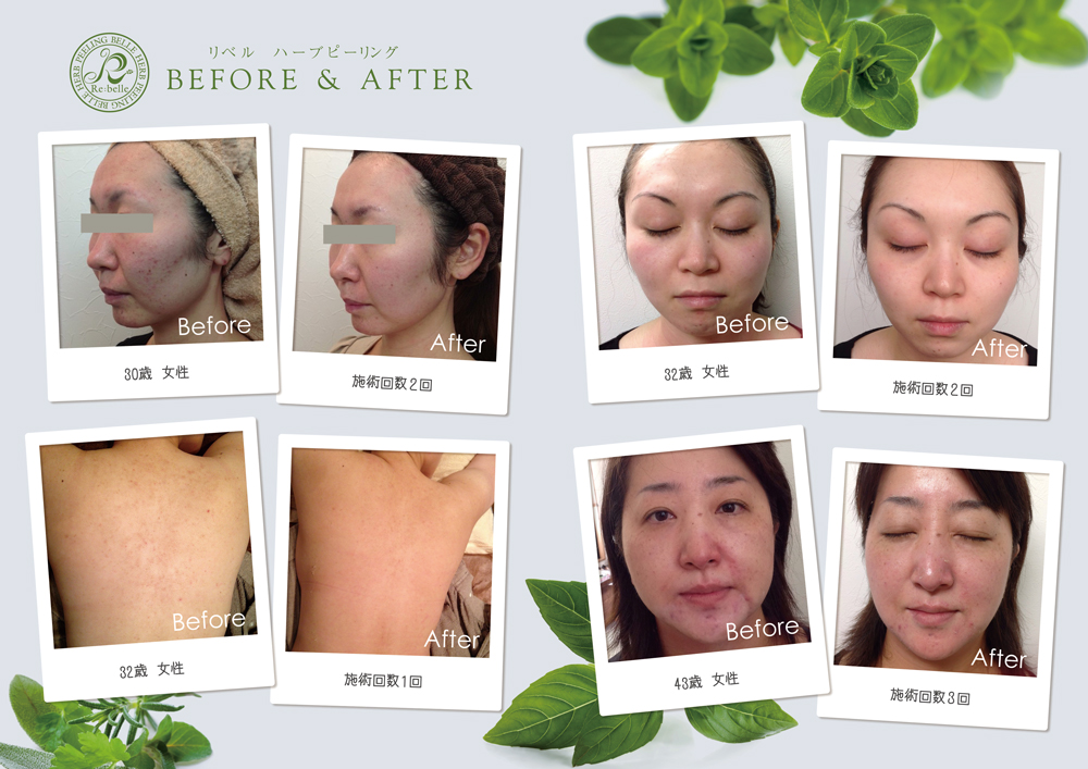 リベルハーブピーリング　ビフォアアプター